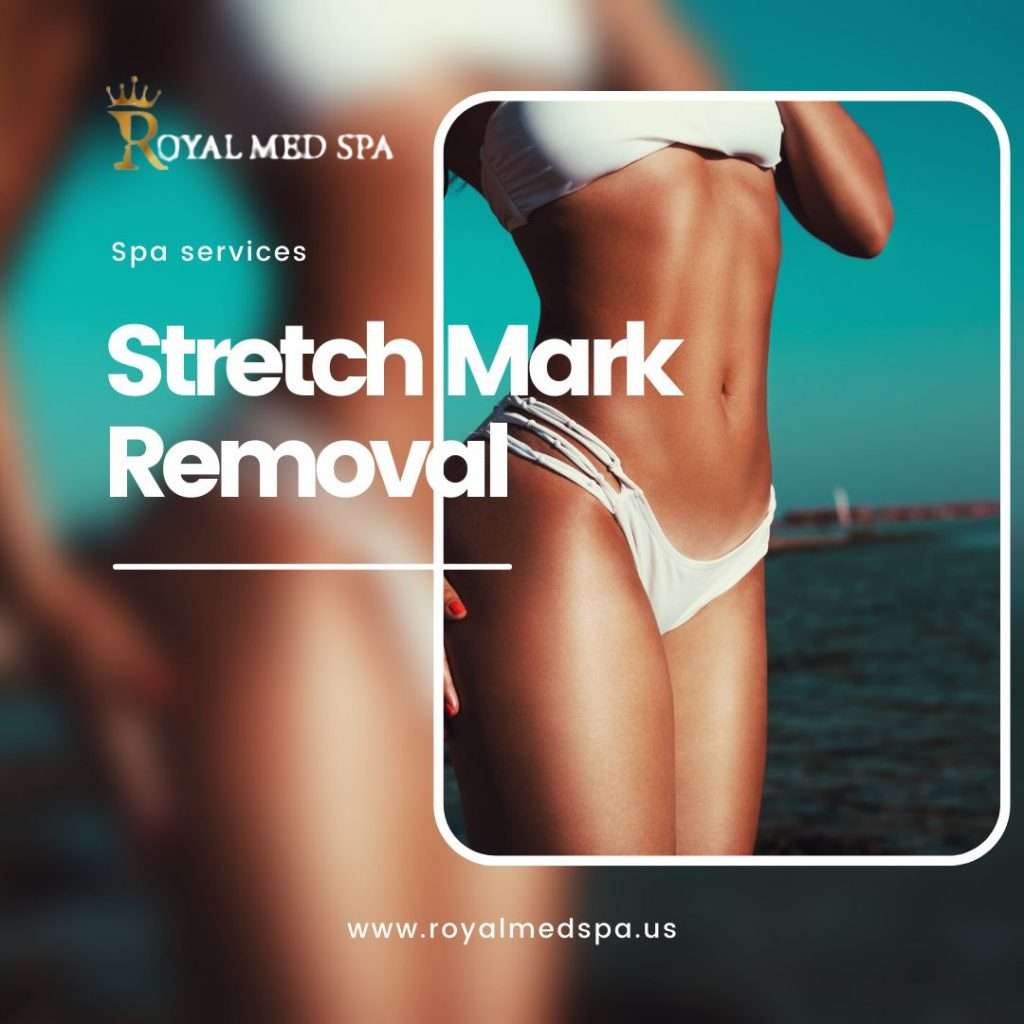 Stretch Mark Removal 