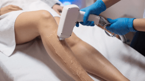 SCLEROTHERAPY