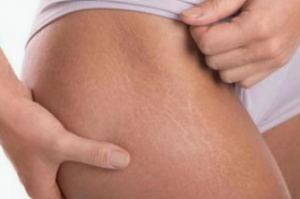 Laser Stretch Mark Removal in NYC